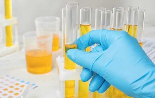آشنایی با برخی علل رنگ غیر طبیعی ادرار آشنایی با بعضی علل رنگ غیر طبیعی ادرار